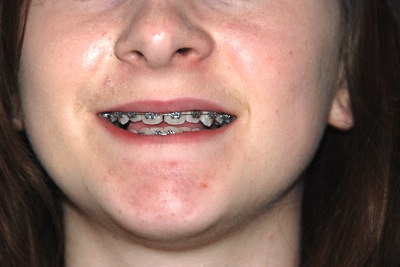 Colour photograph of the lower half of a teenage girl's face, with braces showing.