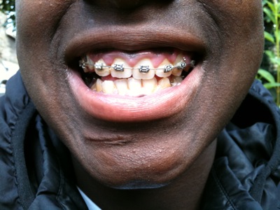 Colour photograph of the lower half of a black teenager's face, with braces on his teeth and a scar below his mouth.