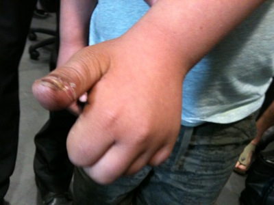 Colour photograph of a small boy's scarred thumb being held towards the camera.
