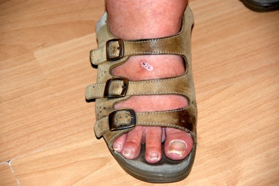 Colour photograph of a woman's sandalled foot with a healing scab, against a background of laminate flooring.